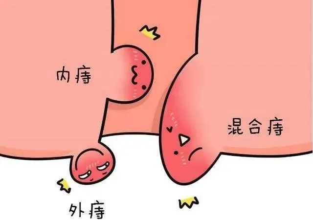 内痔内镜下套扎术，不让“菊花残满地”