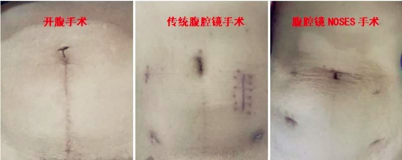 南院区开展首例NOSES手术：直肠肿瘤的微创时代