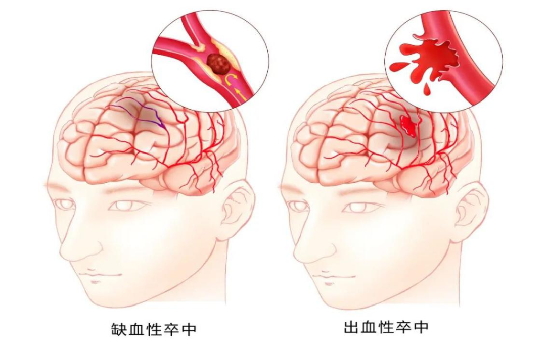 青少年猝死：脑血管意外，注意这些征兆！