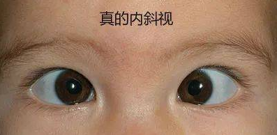 孩子歪头看？斗鸡眼？教您一个自测小妙招，准确分辨真假斜视