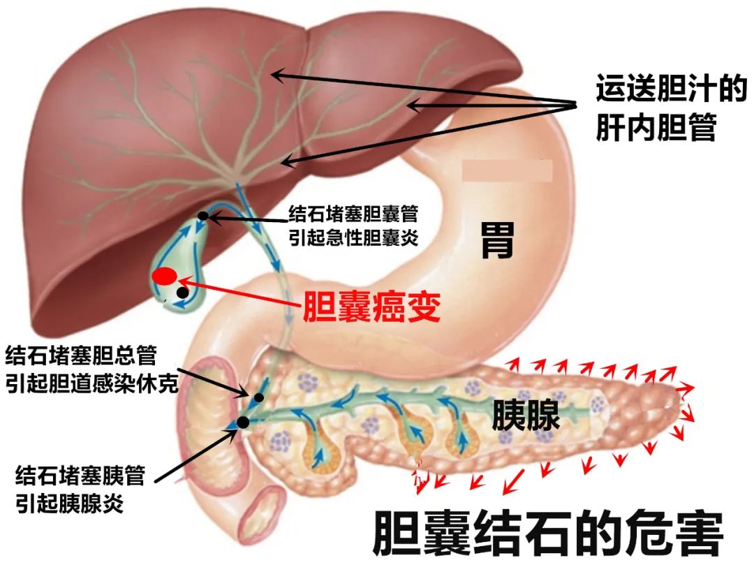 关于胆囊结石，你想知道的答案都在这
