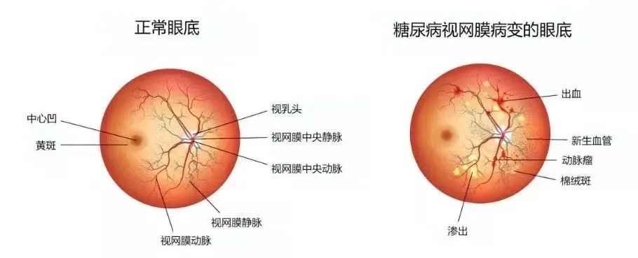 【惠景科普】隐形的视力杀手——糖尿病视网膜病变