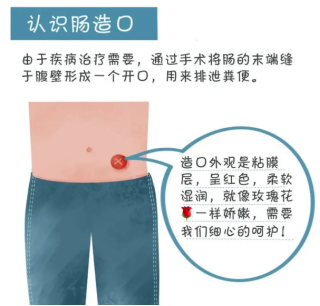 “造口人”居家护理怎么办？玫瑰天使来帮忙！