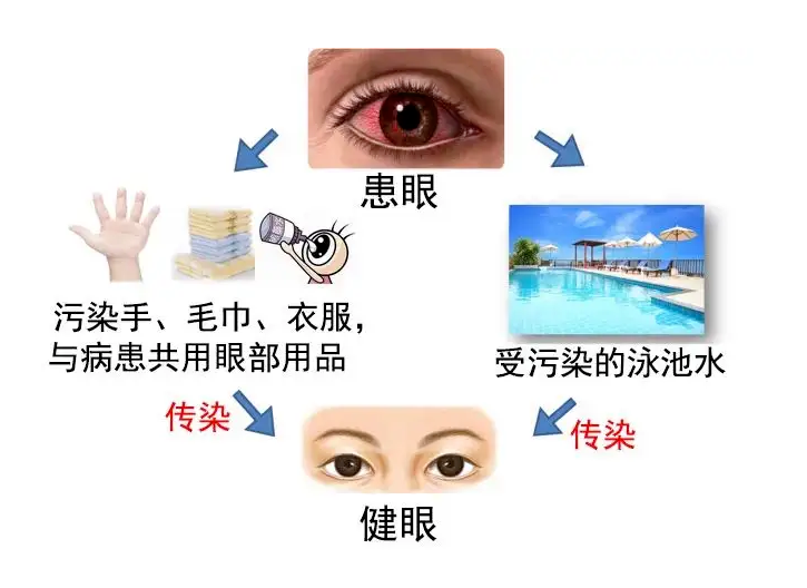 近期“红眼病”高发，如何预防是关键