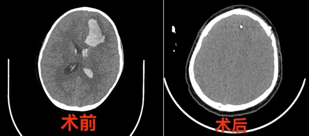 6岁儿童突发颅内出血！这些征兆家长要警惕