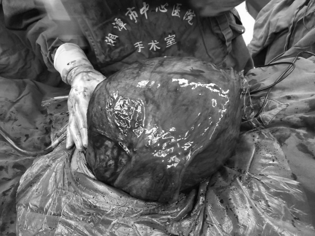 12斤的肿瘤！妇产科主任当场“受到惊吓”