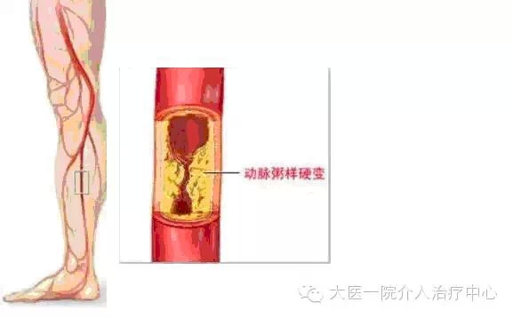 什么症状需要看介入血管病门诊