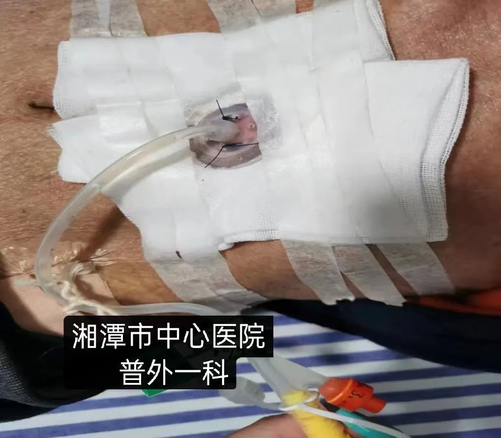 营养双通道 康复快通道