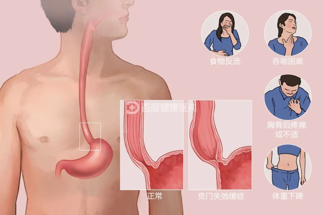 吞咽困难再反复，介入治疗一招除！