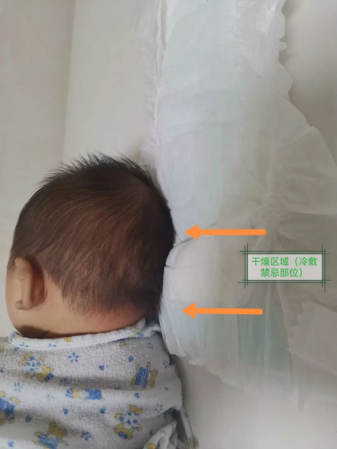 小举措 大关爱 | 儿科二区自制婴儿纸尿裤冰帽的应用