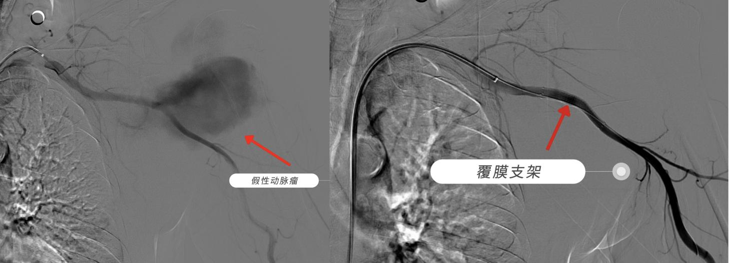 “架”到病除：不开刀也能修补大血管，这处隐匿风险被成功化解