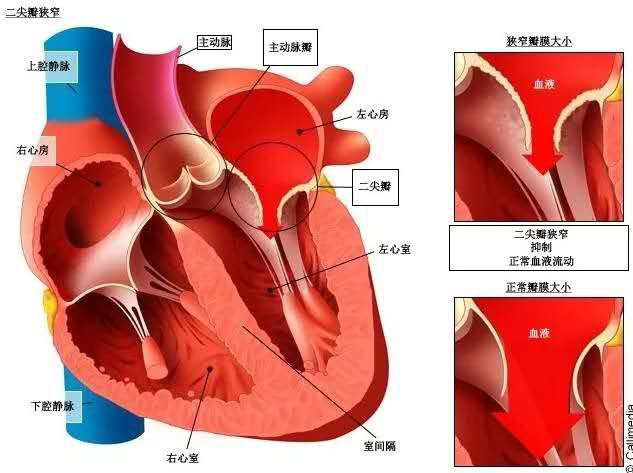 “动心”升级！63岁患者同步更换心脏“阀门+管道”