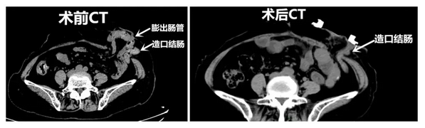 修“疝”补“洞”后，她终于不用躺着吃饭了