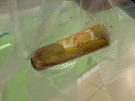 5岁女孩阴道塞异物，医生妙手解难题