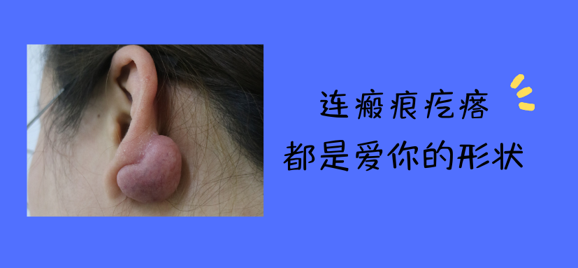 耳垂瘢痕疙瘩新疗法 告别反复复发