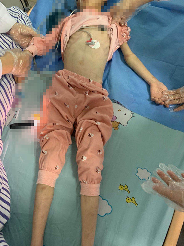 7岁患儿28斤，短期内3次入院，2次手术