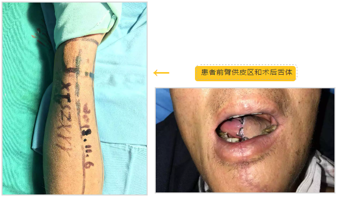 口腔溃疡变舌癌，切了的舌头“缝缝补补”还能用