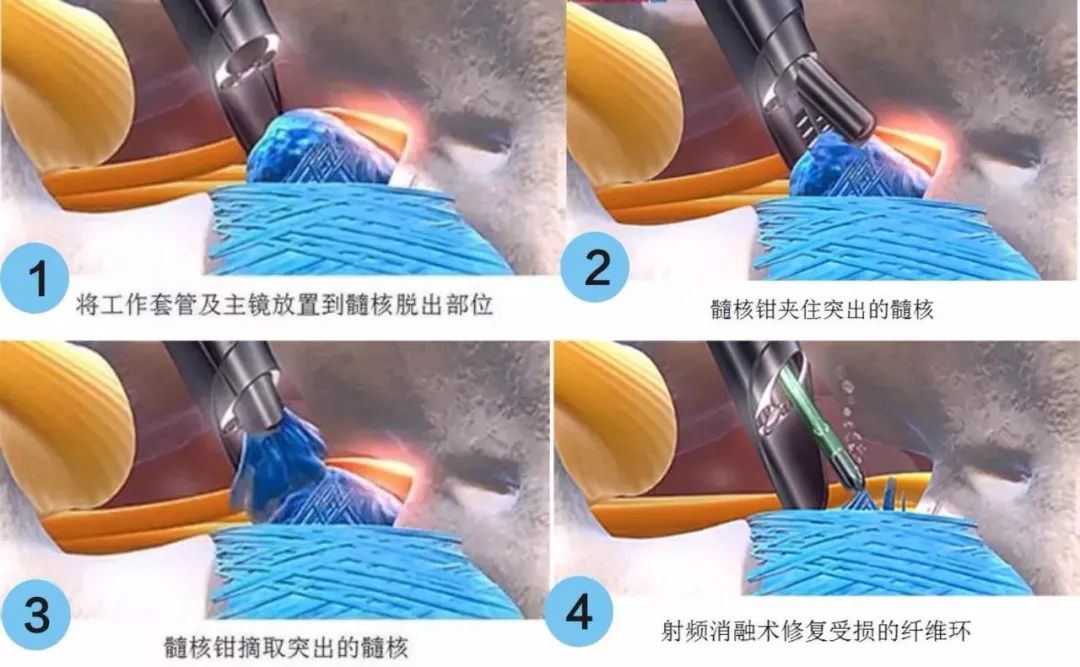 椎间孔镜：小针孔解决腰椎间盘突出“坐立不安”的大难题
