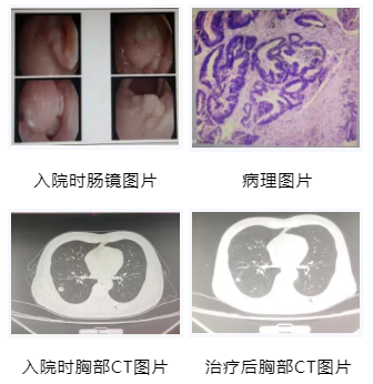【惠景科普】警惕！排便习惯改变小心肠癌