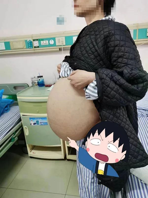18公斤重！医生从“孕妇”肚中取出的是巨大肿瘤